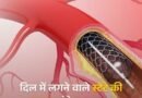 श्रीलंका में मेरिल के तीन हार्ट स्टेंट पर उठे सवाल, भारत में मरीजों की सुरक्षा